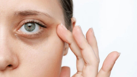 An image of a woman with under eye dark circles.